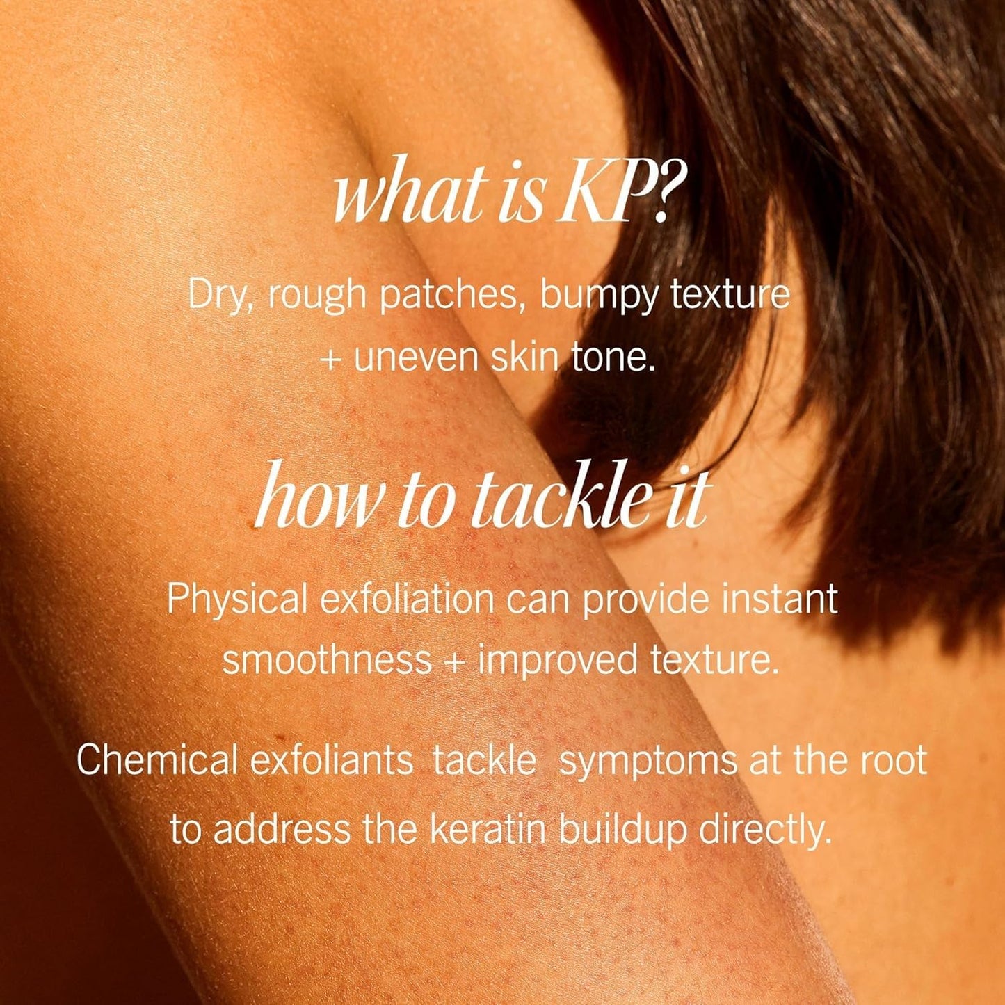 First Aid Beauty - KP Bump Eraser Body Scrub with 10% AHA, Keratosis Pilaris Exfoliator with Glycolic and Lactic acids, Helps Reduce Chicken Skin Bumps, Safe for Sensitive Skin, Peach Scent (8 oz)